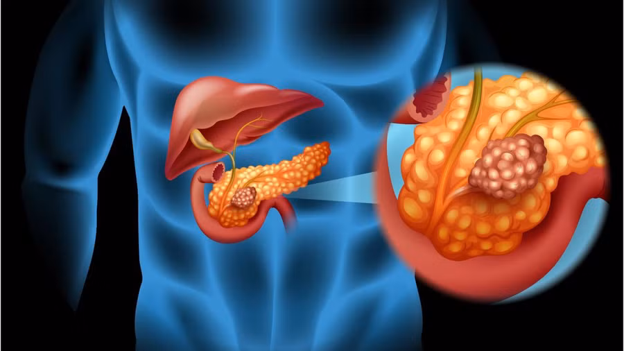 Hầu như tất cả những người mắc ung thư tuyến tụy đều không thể cứu được. Tỷ lệ sống sót sau 5 năm chỉ khoảng 7%. Ảnh: SHUTTERSTOCK