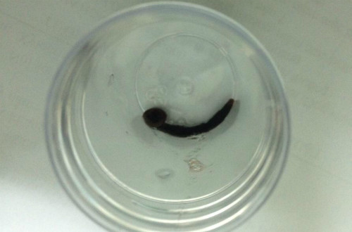  Con đỉa vẫn còn sống khi được bác sĩ Bệnh viện Chợ Rẫy gắp ra khỏi khí quản bệnh nhân.