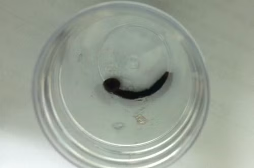  Con đỉa vẫn còn sống khi được bác sĩ Bệnh viện Chợ Rẫy gắp ra khỏi khí quản bệnh nhân.