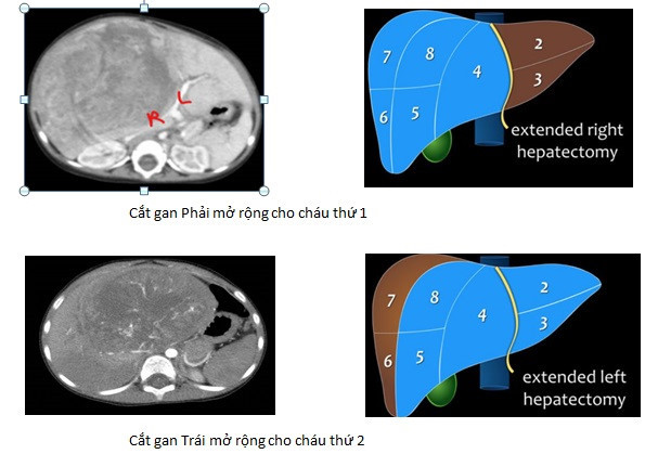 Hình ảnh mô tả hai ca cắt gan lớn ở trẻ em để loại bỏ khối u ung thư nguyên bào tại Bệnh viện T.Ư Huế. Ảnh: BVCC