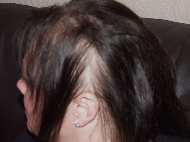 Rụng tóc: Rụng tóc do viêm da đầu thường là triệu chứng đầu tiên của bệnh lupus ban đỏ.. Khi triệu chứng này trở nặng, người bệnh có thể rụng tóc thành từng búi nhỏ. Rụng tóc: Rụng tóc do viêm da đầu thường là triệu chứng đầu tiên của bệnh lupus ban đỏ.. Khi triệu chứng này trở nặng, người bệnh có thể rụng tóc thành từng búi nhỏ.