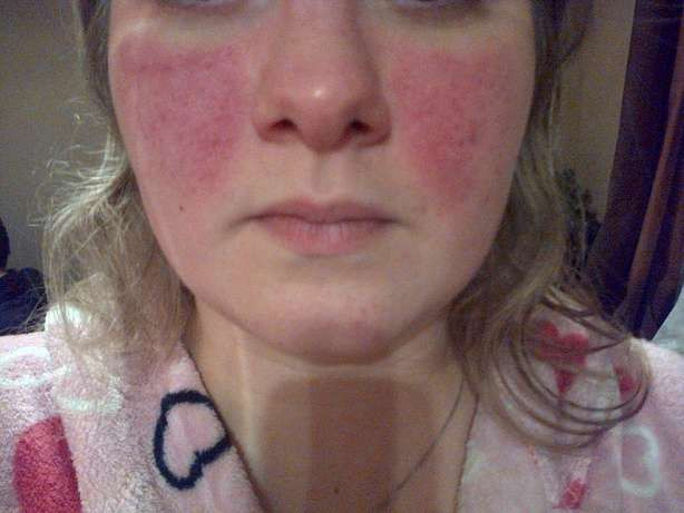 Phát ban: Phát ban là một triệu chứng phổ biến ở bệnh này, do đó bệnh được gọi là lupus ban đỏ. Người bệnh có thể bị nổi những mảng ban đỏ hình cánh bướm ở vùng mũi và hai má. Phát ban: Phát ban là một triệu chứng phổ biến ở bệnh này, do đó bệnh được gọi là lupus ban đỏ. Người bệnh có thể bị nổi những mảng ban đỏ hình cánh bướm ở vùng mũi và hai má.