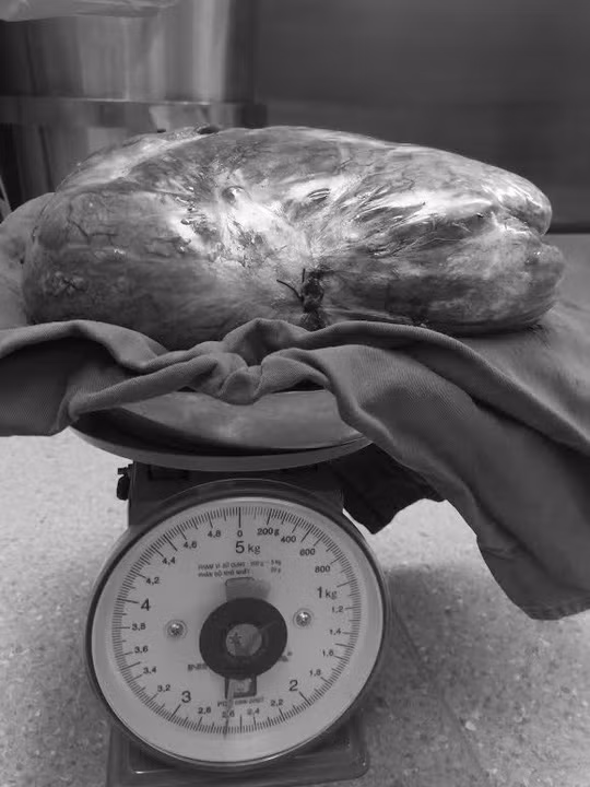 Khối u phổi khổng lồ hiếm gặp