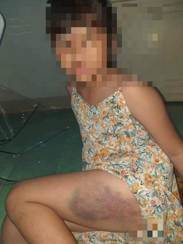 Bé gái nghi bị giáo viên đánh. Bé gái nghi bị giáo viên đánh.