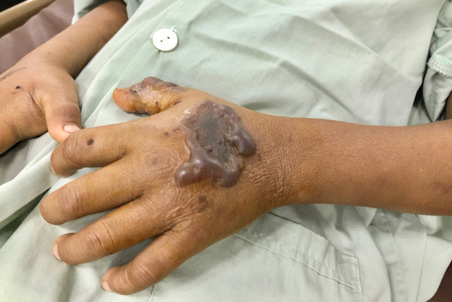 Vết cắn của rắn lục đuôi đỏ trên tay bệnh nhi Đinh Lý Duy.