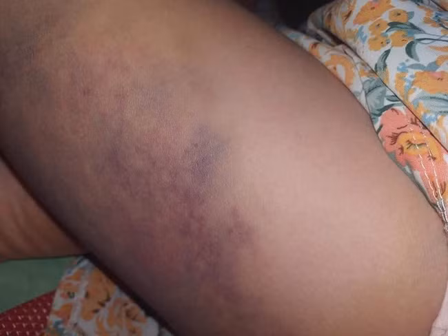 Vết thâm tím trên đùi cháu bé.