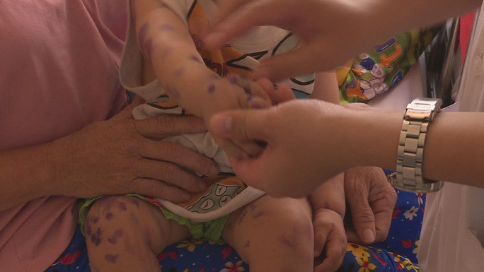 Bệnh tay chân miệng bùng phát tại Đắk Lắk