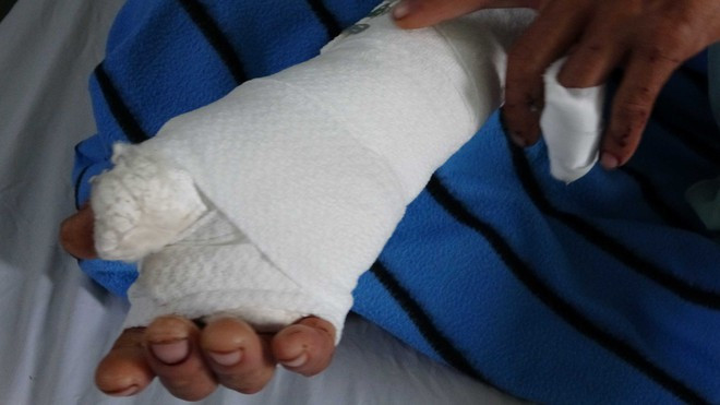 Anh N.V.T. bị khỉ cắn nát bàn tay phải, mất nhiều máu và ngất xỉu trước khi đưa đi bệnh viện.