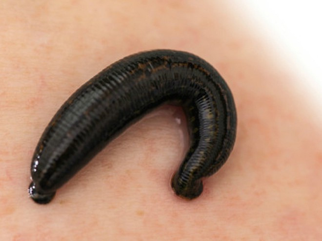 Con đỉa đã nằm trong cổ họng bé Tiêu Dao ở Trung Quốc trong suốt hơn 1 năm.