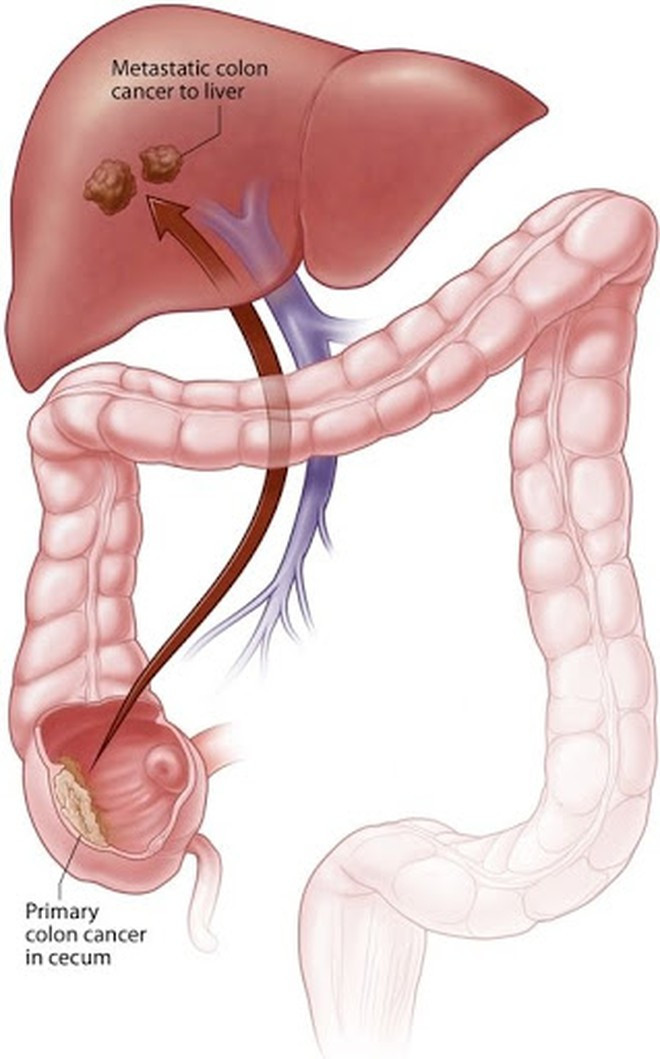 Ung thư đại tràng có thể di căn đến gan thông qua một mạch máu kết nối ruột và gan ẢNH MINH HỌA: SHUTTERSTOCK