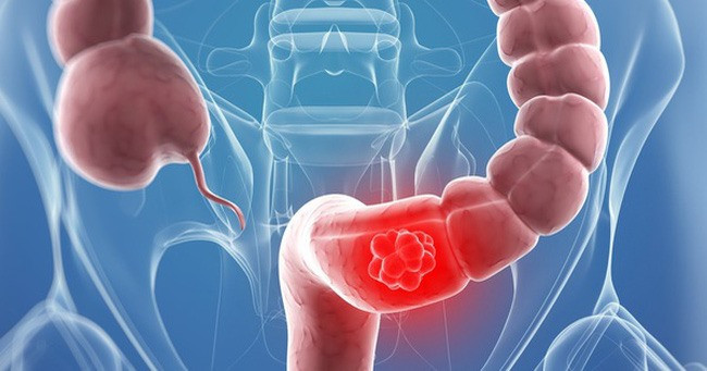 Ung thư trực tràng là kẻ thù “thầm lặng” với người trẻ. Ảnh: Bộ Y tế