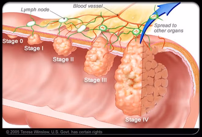 Ung thư đại tràng giai đoạn 4 là giai đoạn nặng nhất, vì lúc đó, các tế bào ung thư đã di căn đến các cơ quan khác ẢNH MINH HỌA: SHUTTERSTOCK