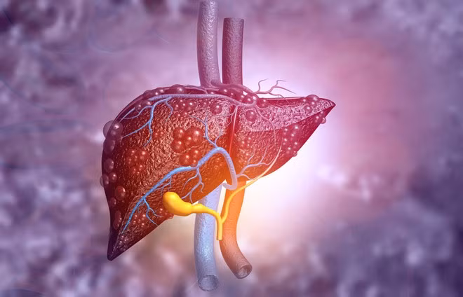 Bệnh gan nhiễm mỡ có thể được điều trị bằng cách áp dụng chế độ ăn uống và thay đổi lối sống ẢNH MINH HỌA: SHUTTERSTOCK