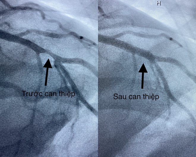 Hình ảnh mạch vành của bệnh nhân bị hẹp nặng trước can thiệp và sau khi được đặt stent phủ thuốc tái thông mạch máu. Ảnh Đình Tuyển Hình ảnh mạch vành của bệnh nhân bị hẹp nặng trước can thiệp và sau khi được đặt stent phủ thuốc tái thông mạch máu. Ảnh Đình Tuyển