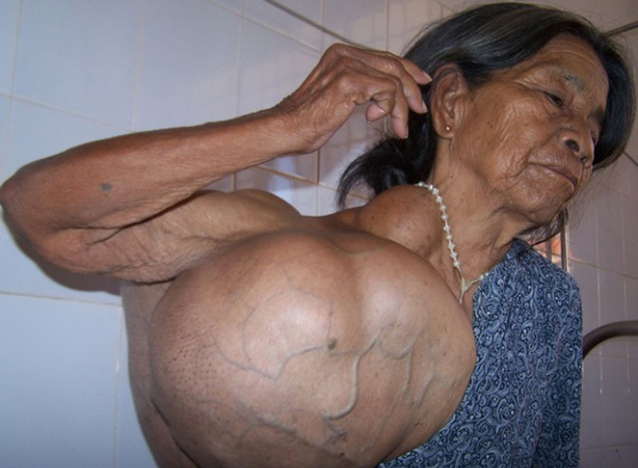 Khối u của bà Y Tỏ trước khi được phẫu thuật. Ảnh: Duy Tân