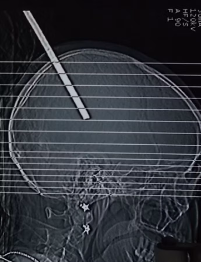 Phim chụp cây sắt đâm xuyên vào hộp sọ của bệnh nhân. Ảnh: Bình Nguyên