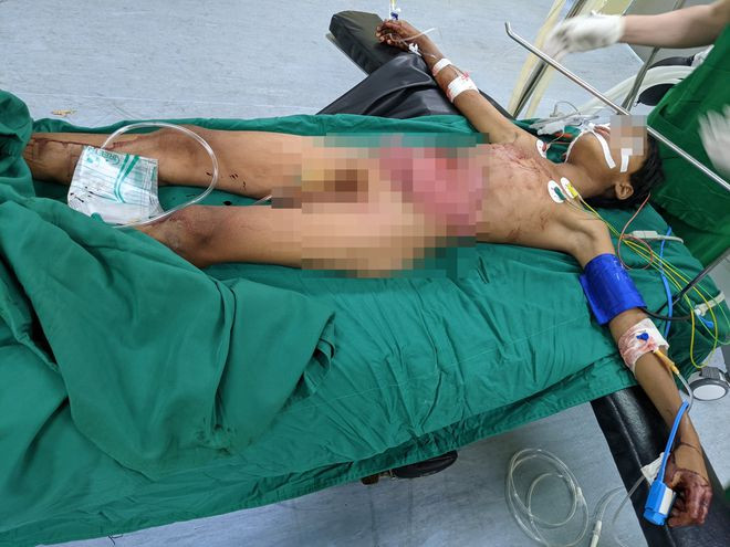 Bệnh nhân bị toạc thành bụng, lòi toàn bộ nội tạng ra ngoài ẢNH: ĐỨC NHẬT