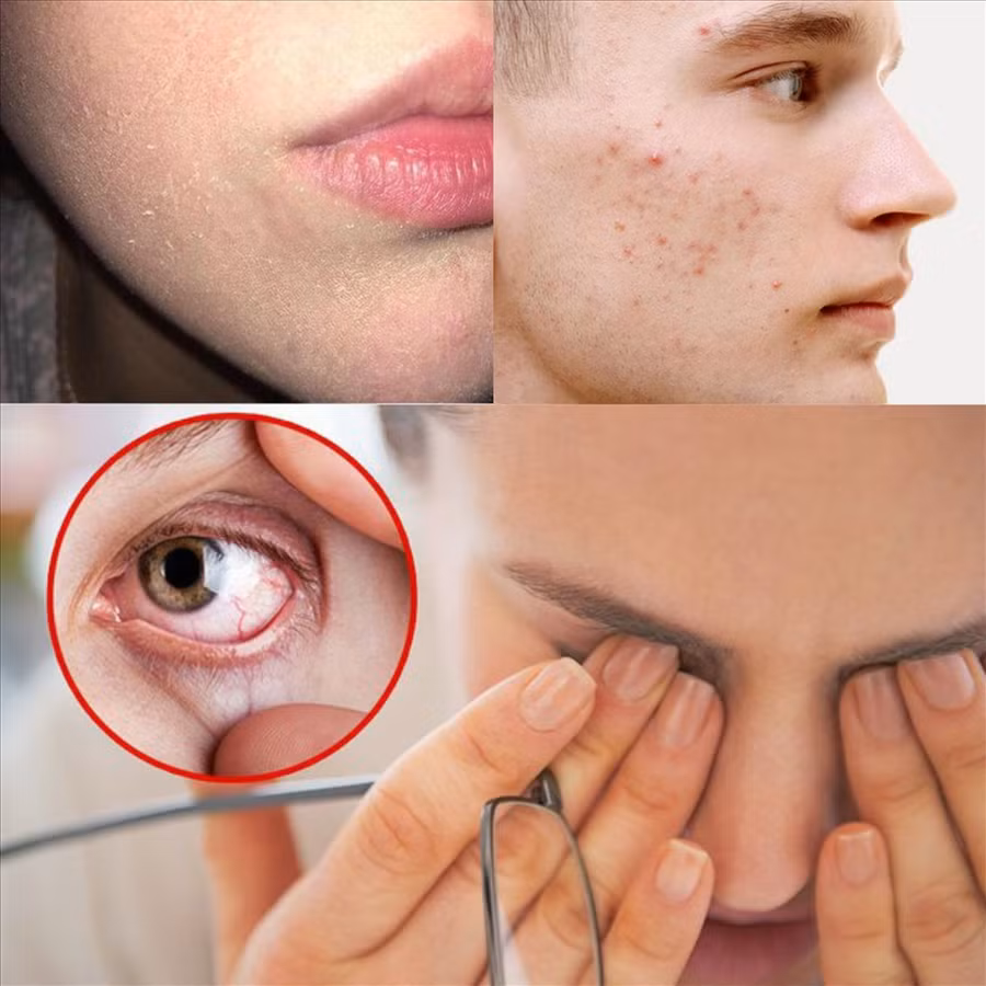 6 dấu hiệu nhận biết cơ thể cần bổ sung vitamin A. Đồ hoạ: Thuý Vi