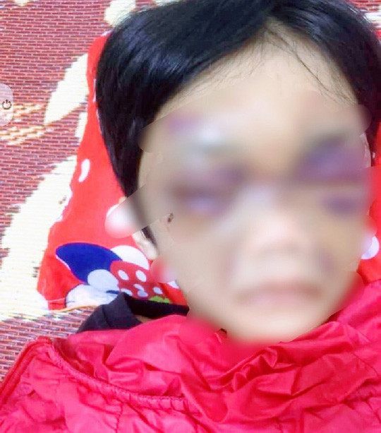 Cháu C bị mẹ đẻ hành hạ thâm tím mặt mày Cháu C bị mẹ đẻ hành hạ thâm tím mặt mày