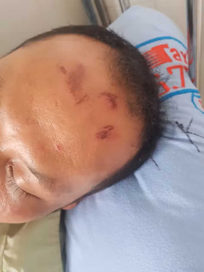 Vết thương trên đầu ông Nghị sau khi bị đánh.