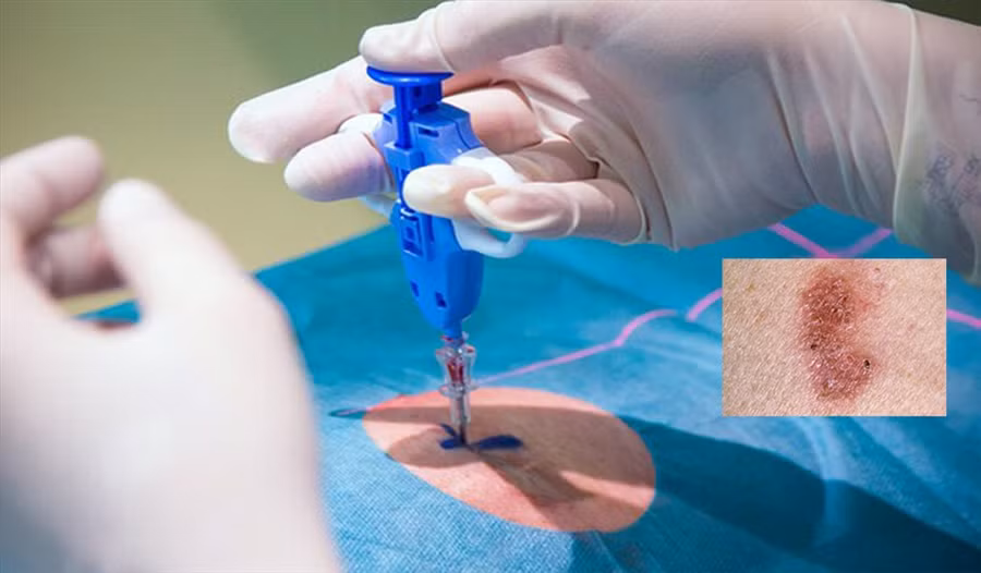 Sinh thiết da khi xuất hiện các dấu hiệu của ung thư da. Đồ họa: Hồng Nhật
