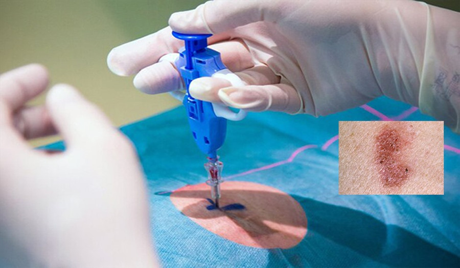 Sinh thiết da khi xuất hiện các dấu hiệu của ung thư da. Đồ họa: Hồng Nhật