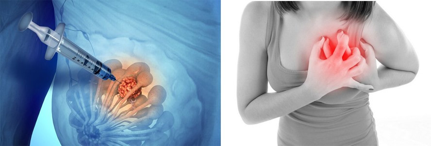 Phương pháp xét nghiệm sinh thiết kim. Đồ họa: Hồng Nhật