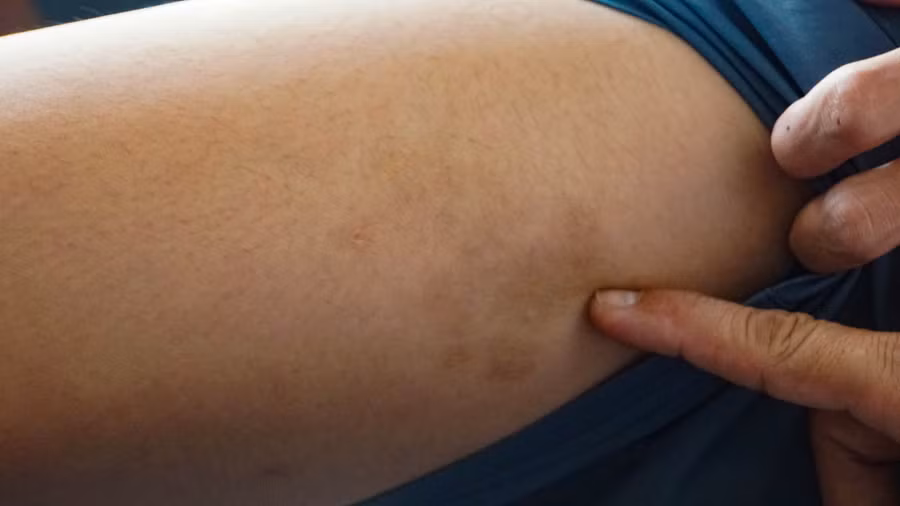 Vết bầm còn trên đùi anh T.P.V. Ảnh: Hải Phong