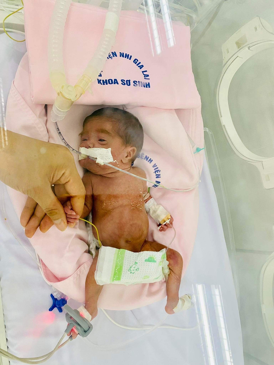 Sau hơn 40 ngày chăm sóc, bé gái sinh non nặng 580 gram đã tăng lên 910 gram. Ảnh: Bệnh viện cung cấp Sau hơn 40 ngày chăm sóc, bé gái sinh non nặng 580g đã tăng lên 910g. Ảnh: Bệnh viện cung cấp