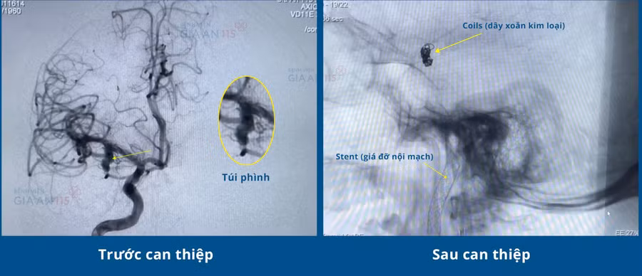  Hình ảnh trước và sau can thiệp nội mạch điều trị phình động mạch não. Ảnh: BSCC
