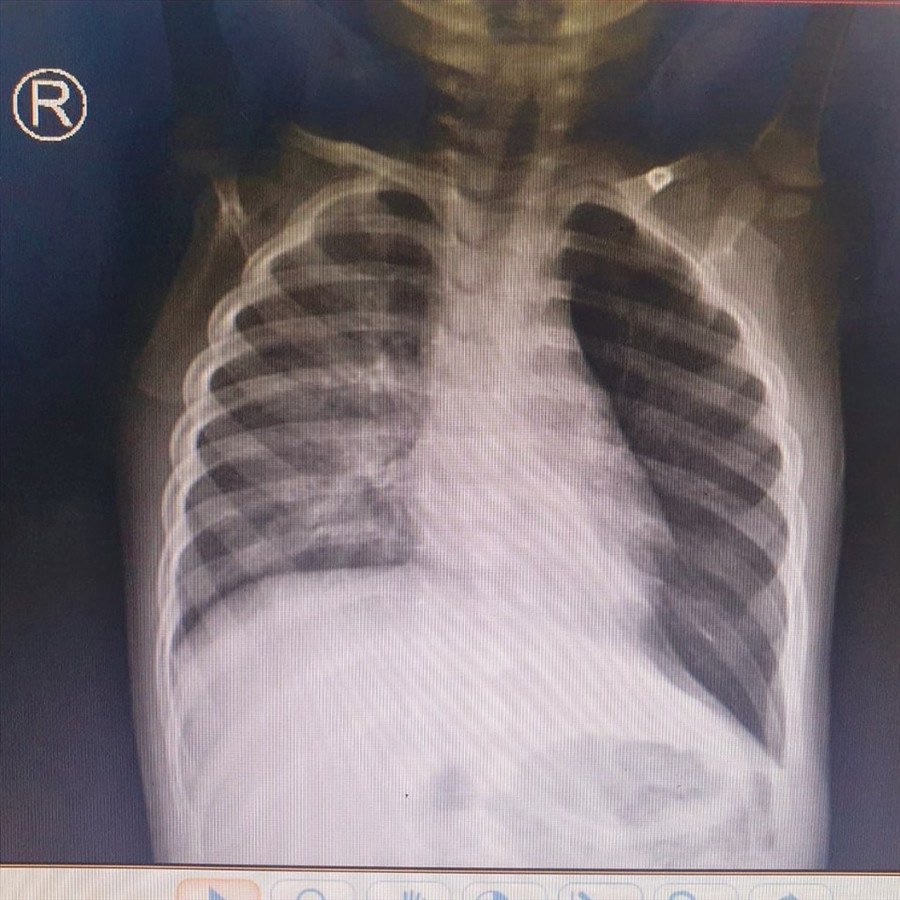  Bệnh nhi ăn đậu phộng rồi bị hít sặc vào đường thở. Ảnh: BV