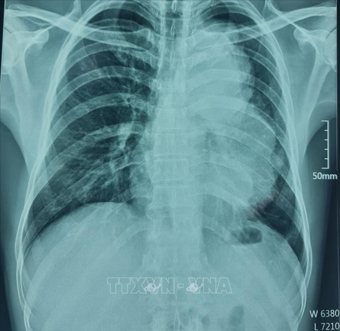 Hình ảnh cận lâm sàng bệnh nhân A. B (50 tuổi, trú xã Măng Bút, huyện Kon Plông, tỉnh Kon Tum) có u trong lồng ngực kích thước lớn. Ảnh: TTXVN phát