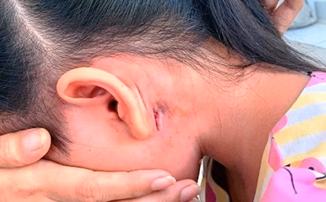 Đắk Lắk đã ghi nhận trường hợp mắc bệnh 