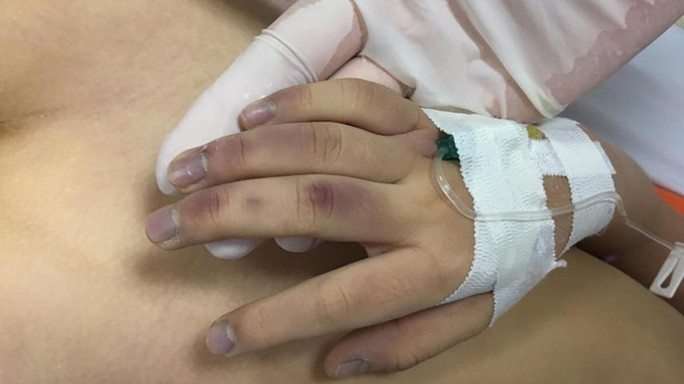  Nhiều vết bầm tím trên cơ thể bé H.A.