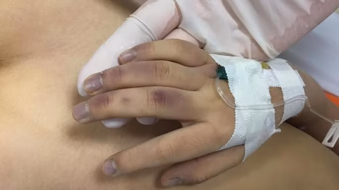 Nhiều vết bầm tím trên cơ thể bé H.A. Nhiều vết bầm tím trên cơ thể bé H.A.