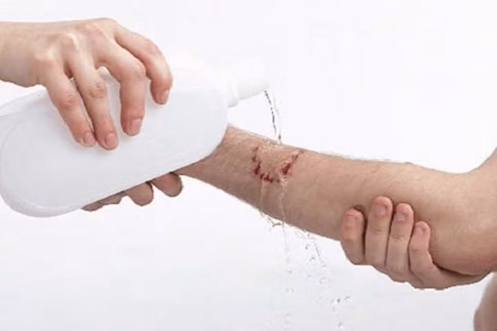 Xối rửa kỹ tất cả các vết cắn/cào trong 15 phút với nước và xà phòng hoặc nước sạch