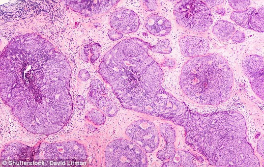 110 gene liên quan đến ung thư vú mới được phát hiện đem lại hy vọng cho các phương pháp chẩn đoán và điều trị mới hiệu quả hơn - ảnh: SHUTTERSTOCK 110 gene liên quan đến ung thư vú mới được phát hiện đem lại hy vọng cho các phương pháp chẩn đoán và điều trị mới hiệu quả hơn - ảnh: SHUTTERSTOCK