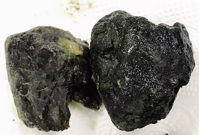 Thói quen ăn uống không khoa học, thường xuyên uống trà sữa có thể là nguyên nhân gây tắc ruột Thói quen ăn uống không khoa học, thường xuyên uống trà sữa có thể là nguyên nhân gây tắc ruột