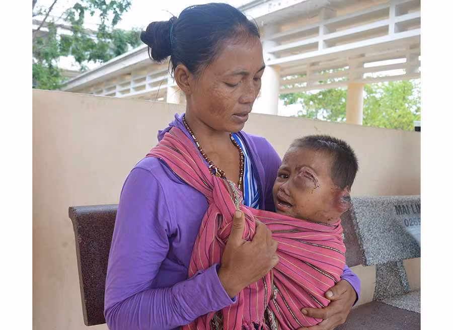  Sự sống của bé H'Cha chỉ tính từng ngày. Ảnh: A.H