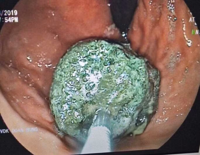  Khối bã thức ăn lớn được tìm thấy trong dạ dày nam thanh niên - Ảnh: Bác sĩ cung cấp