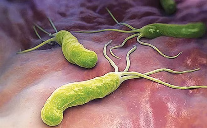  Vi khuẩn HP gây nhiều tác hại cho sức khỏe hơn bạn nghĩ