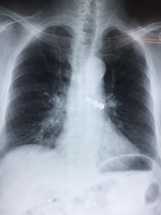 Dị vật nằm sâu trong phế quản khiến bệnh nhân khó thở, đe doạ tính mạng - Ảnh: Bác sĩ cung cấp