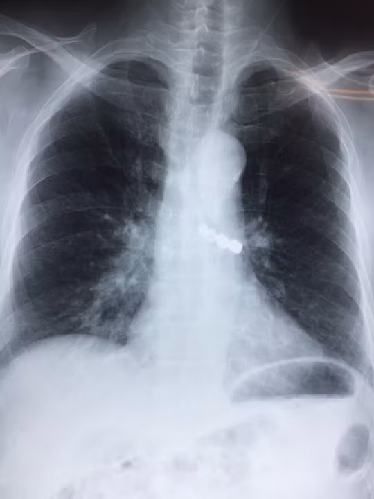 Dị vật nằm sâu trong phế quản khiến bệnh nhân khó thở, đe doạ tính mạng - Ảnh: Bác sĩ cung cấp