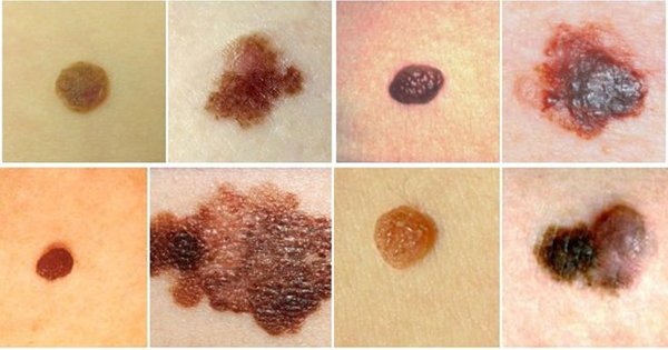 Bằng mắt thường có thể dễ dàng phát hiện nhiều điểm bất thường ở các nốt ruồi ác tính 