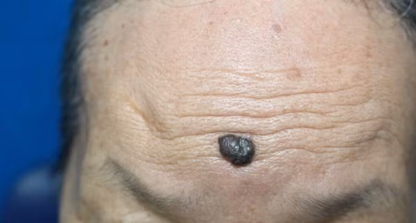 Nhiều người lầm tưởng nốt đen lớn trên mặt là nốt ruồi bình thường