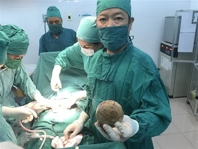  Êkíp bác sỹ Bệnh viện đa khoa khu vực Định Quán phẫu thuật lấy viên sỏi 