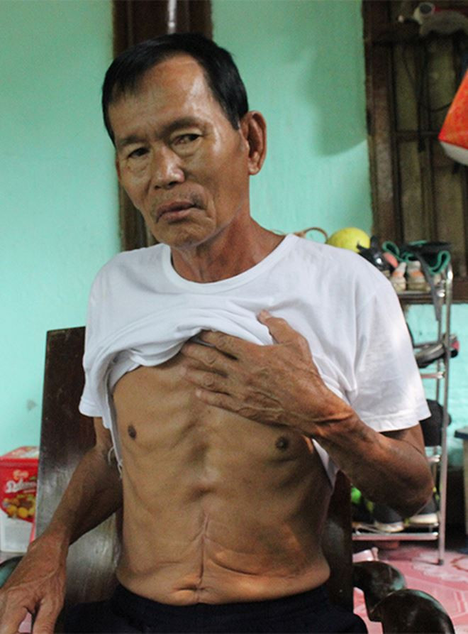 Ông Bình bị thương trong một trận chiến đấu và mất trí nhớ 