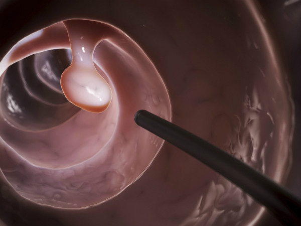  Nội soi đại tràng để phát hiện polyp và điều trị ung thư sớm. Ảnh: RH