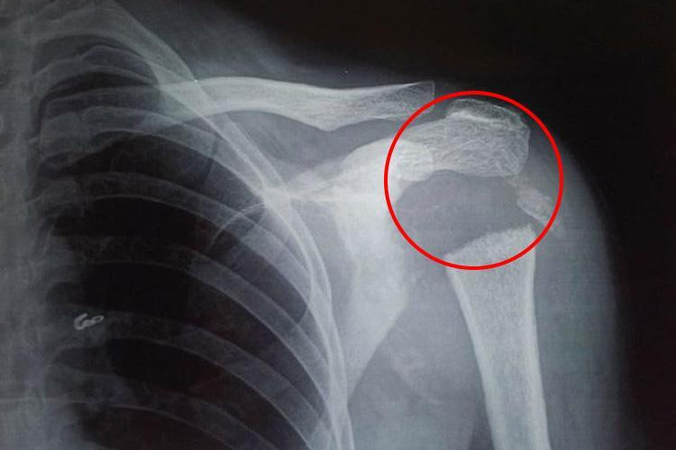 Sau khi tiến hành chụp X quang cùng nhiều xét nghiệm khác, các bác sĩ chẩn đoán cô mắc chứng bệnh hiếm gặp có tên Gorham-Stout.