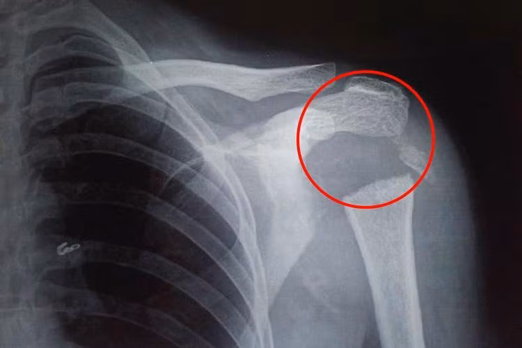 Sau khi tiến hành chụp X quang cùng nhiều xét nghiệm khác, các bác sĩ chẩn đoán cô mắc chứng bệnh hiếm gặp có tên Gorham-Stout.